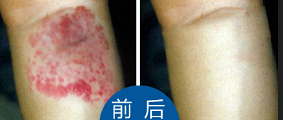 血管瘤