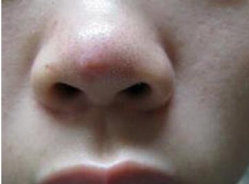 为什么鼻子上会长痘?