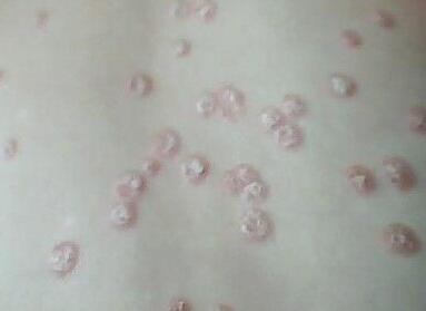 牛皮癣常见的有几种?亳州那看牛皮癣